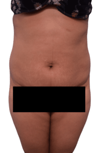 Before Image: Tummy Tuck