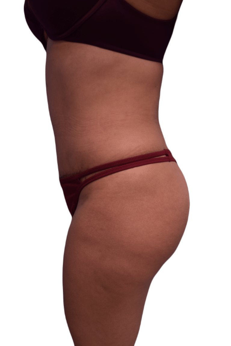 After Image: Tummy Tuck - left-side