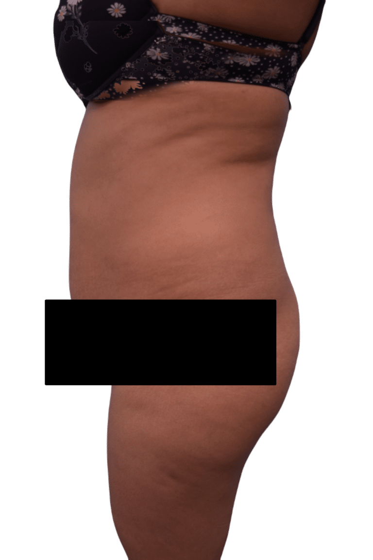 Before Image: Tummy Tuck - left-side