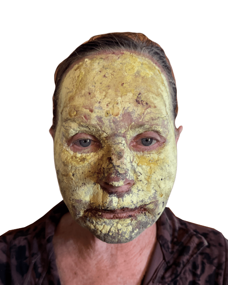 Before Image: Croton Oil Peel - front