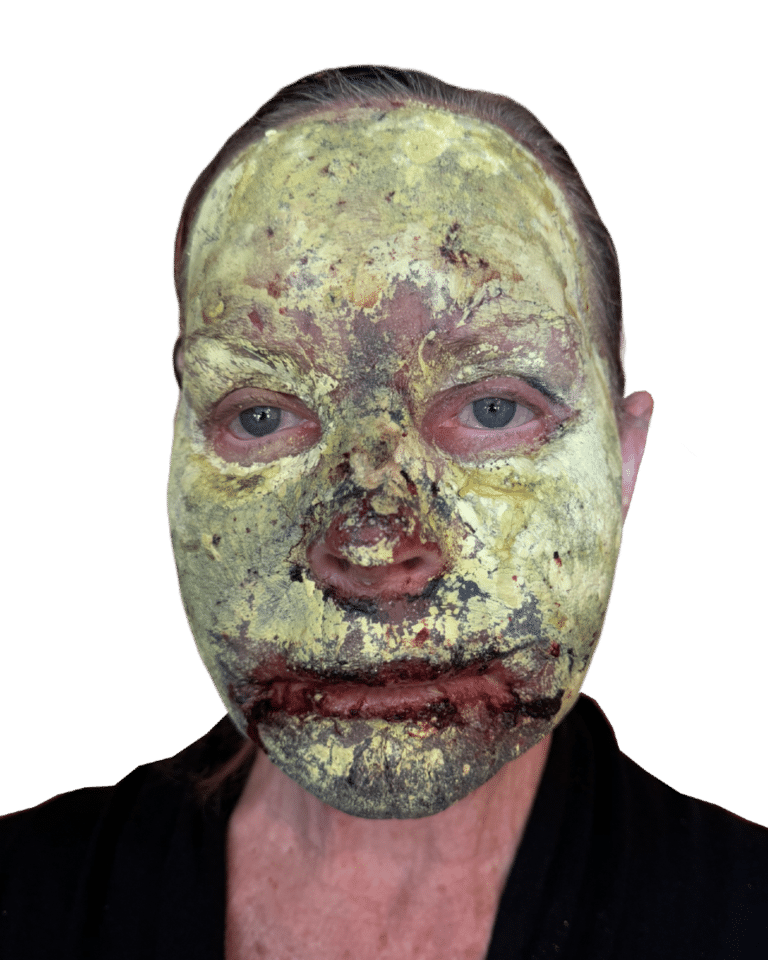 After Image: Croton Oil Peel - front
