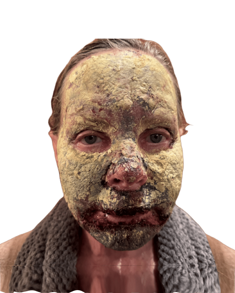 After Image: Croton Oil Peel - front