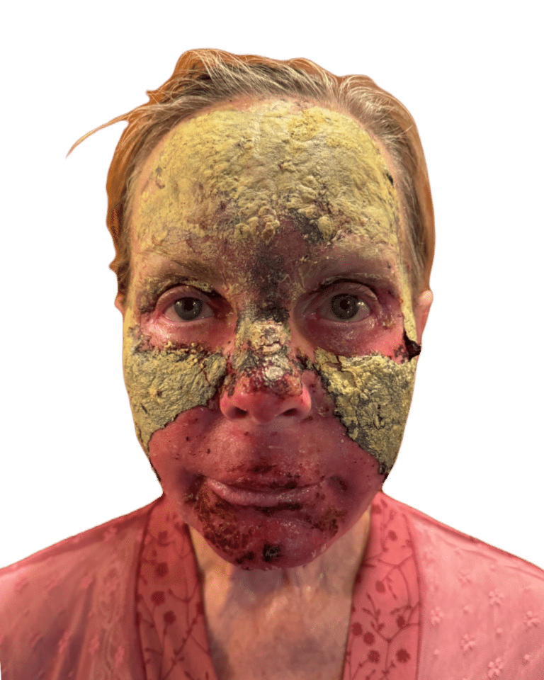 Before Image: Croton Oil Peel - front