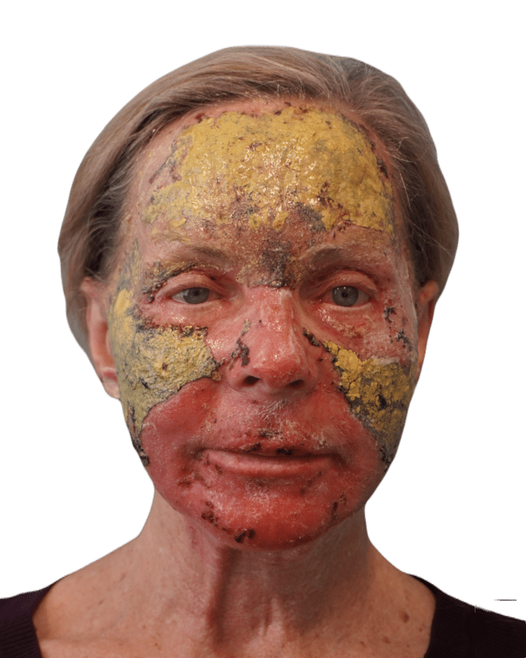 After Image: Croton Oil Peel - front