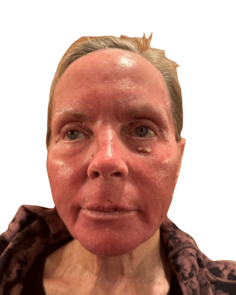 Before Image: Croton Oil Peel - front