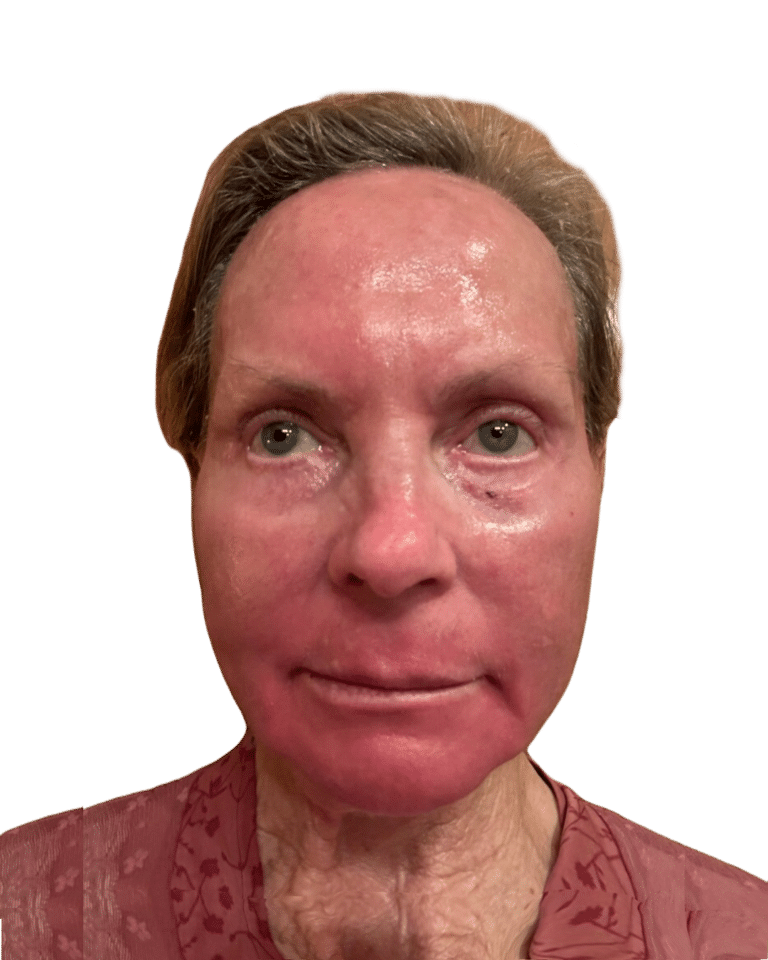 After Image: Croton Oil Peel - front