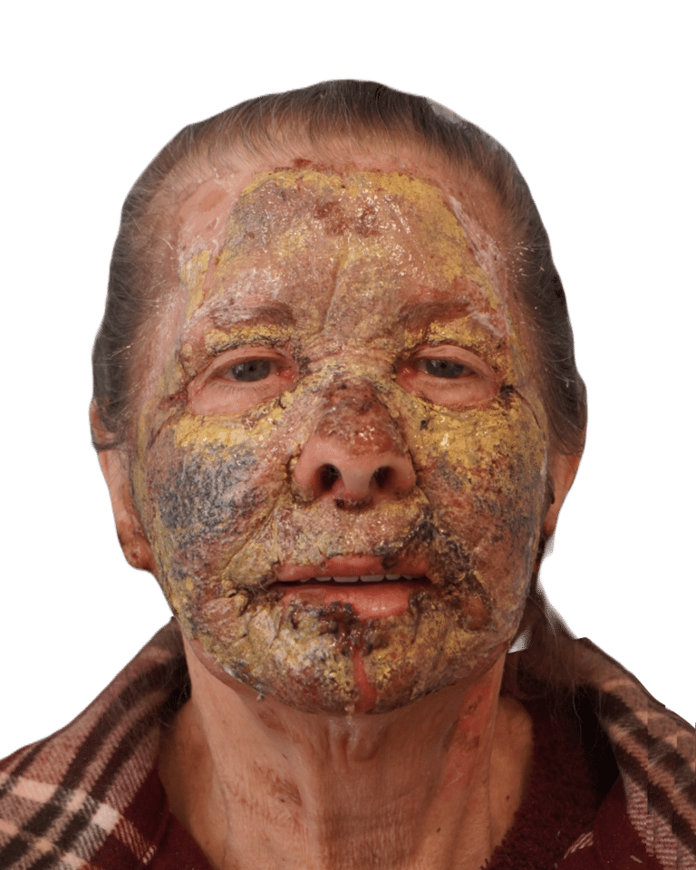 Before Image: Croton Oil Peel - front
