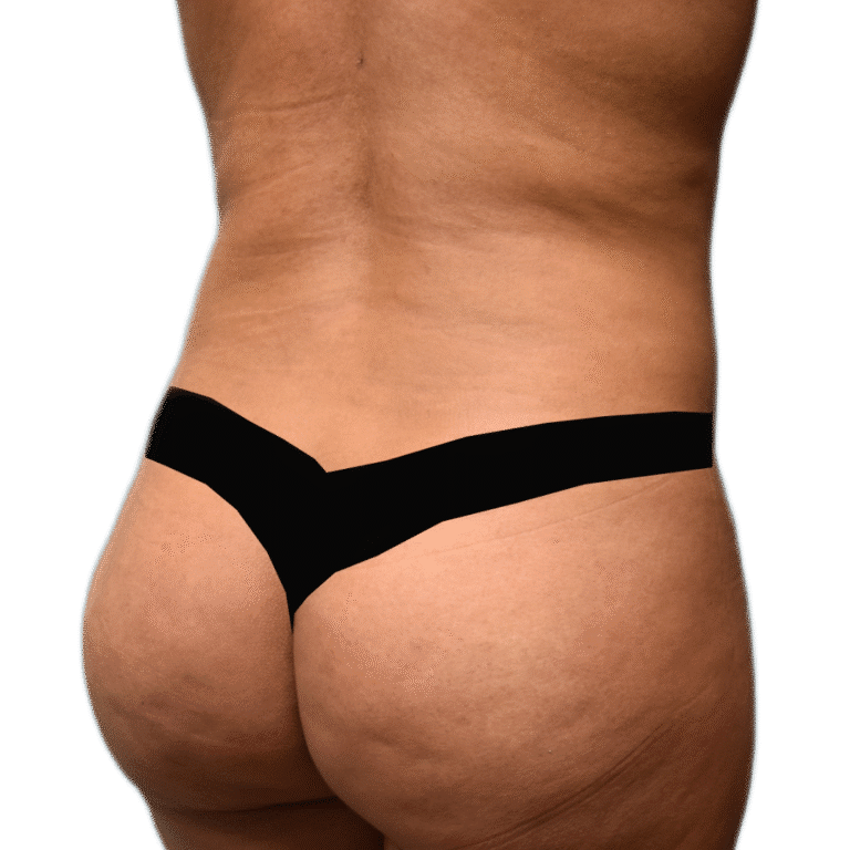 After Image: BBL - right-back-oblique