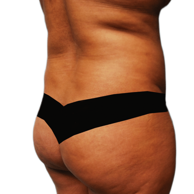 Before Image: BBL - right-back-oblique