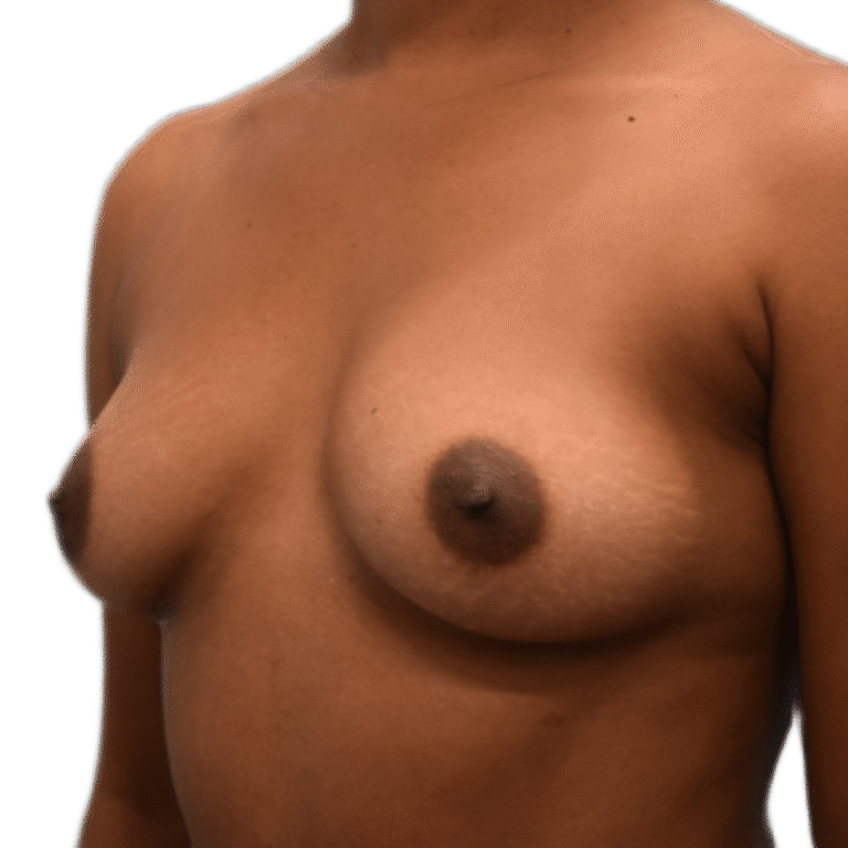 Before Image: Breast Augmentation - left-front-oblique