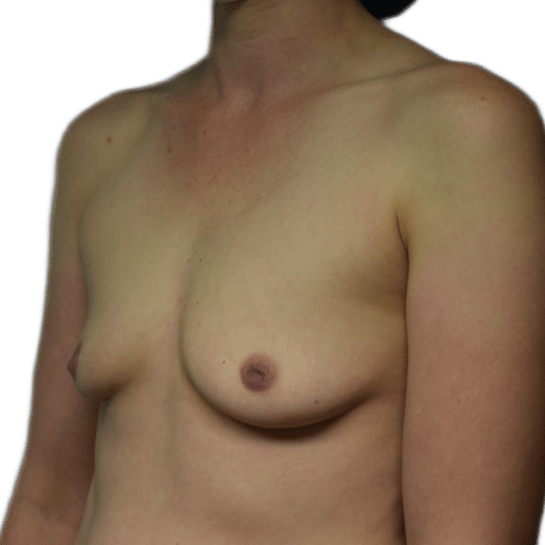 Before Image: Breast Augmentation - left-front-oblique