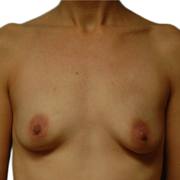 Before Image: Breast Augmentation - front