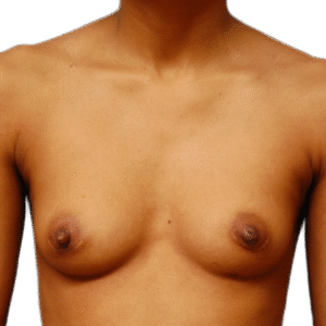 Before Image: Breast Augmentation