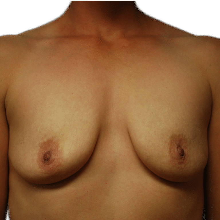 Before Image: Breast Augmentation - front