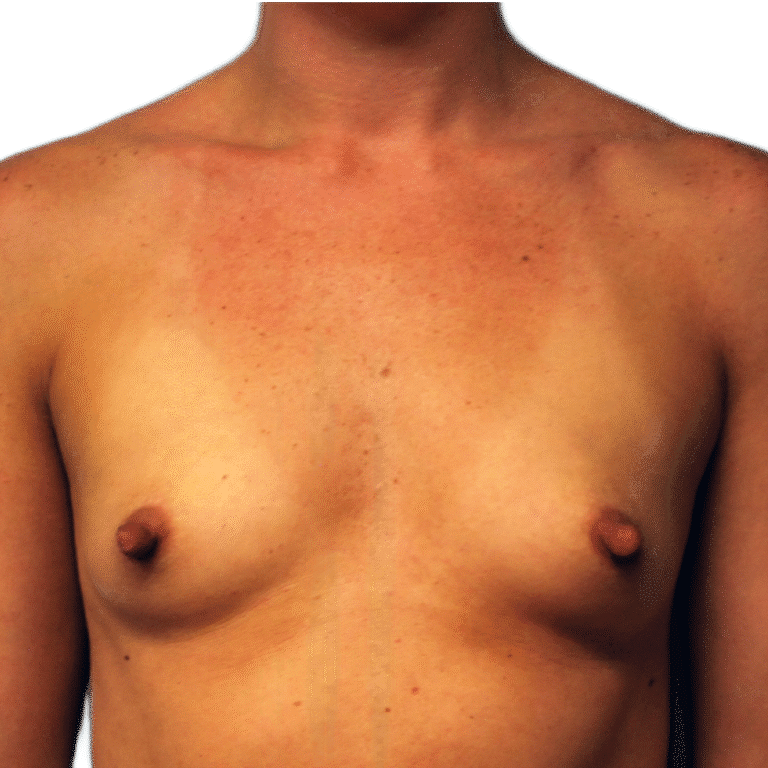 Before Image: Breast Augmentation - front