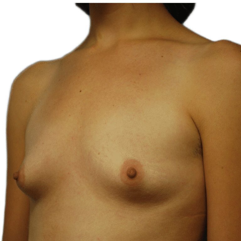 Before Image: Breast Augmentation - left-front-oblique