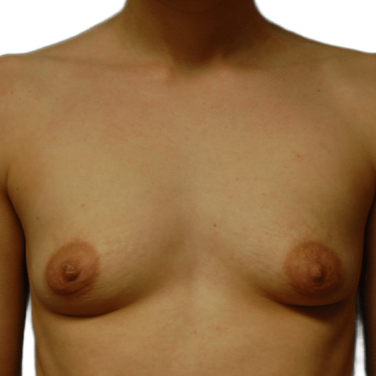 Before Image: Breast Augmentation - front