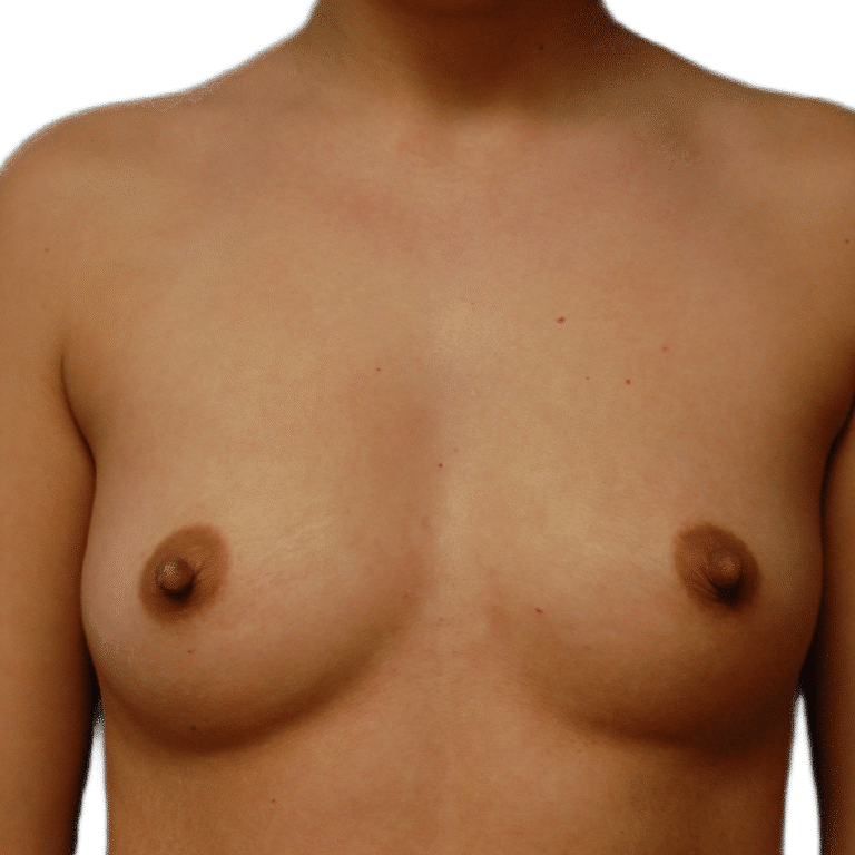 Before Image: Breast Augmentation - front