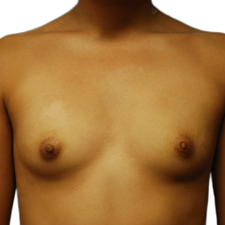 Before Image: Breast Augmentation - front