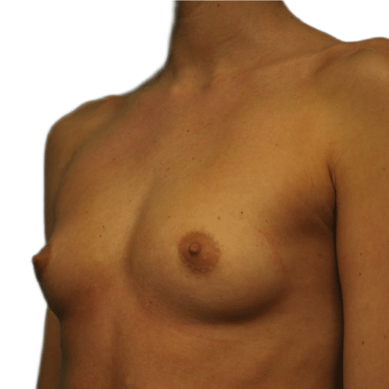 Before Image: Breast Augmentation - left-front-oblique