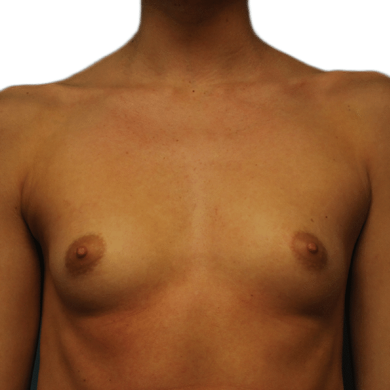 Before Image: Breast Augmentation - front