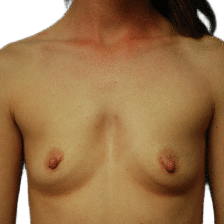 Before Image: Breast Augmentation - front