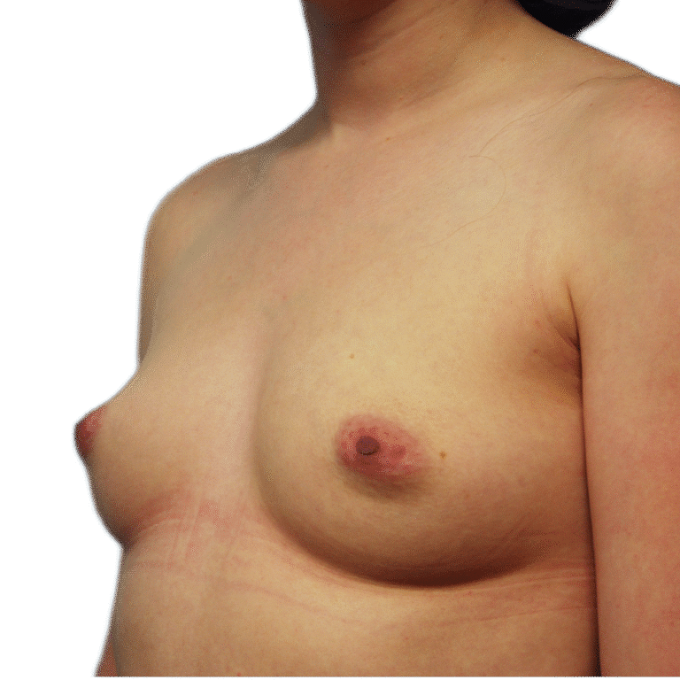 Before Image: Breast Augmentation - left-front-oblique