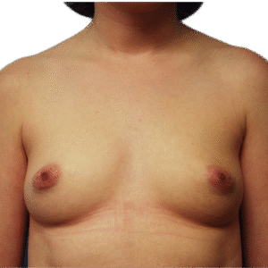 Before Image: Breast Augmentation