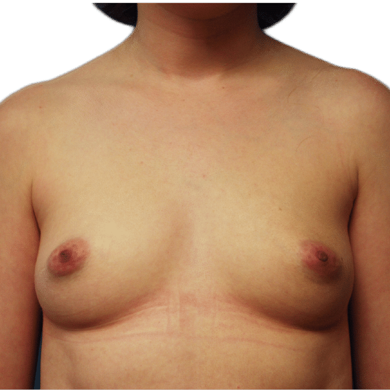 Before Image: Breast Augmentation - front