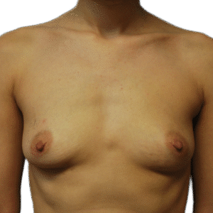 Before Image: Breast Augmentation