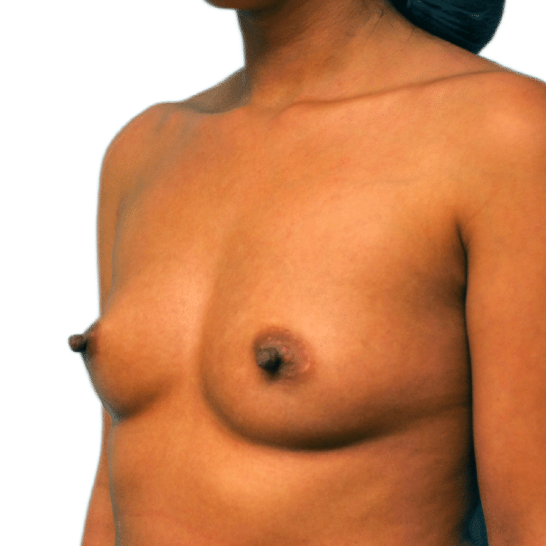Before Image: Breast Augmentation - left-front-oblique