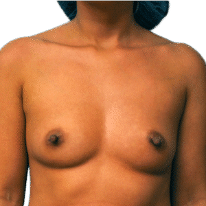 Before Image: Breast Augmentation