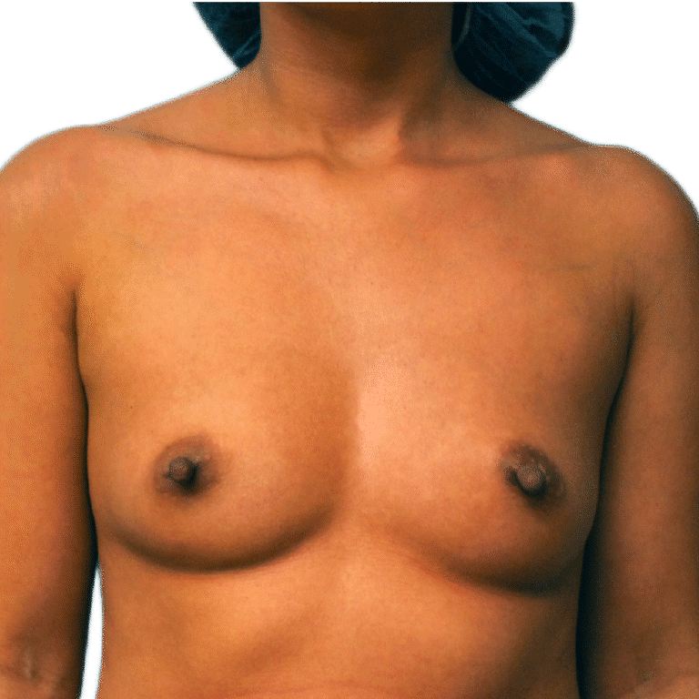 Before Image: Breast Augmentation - front