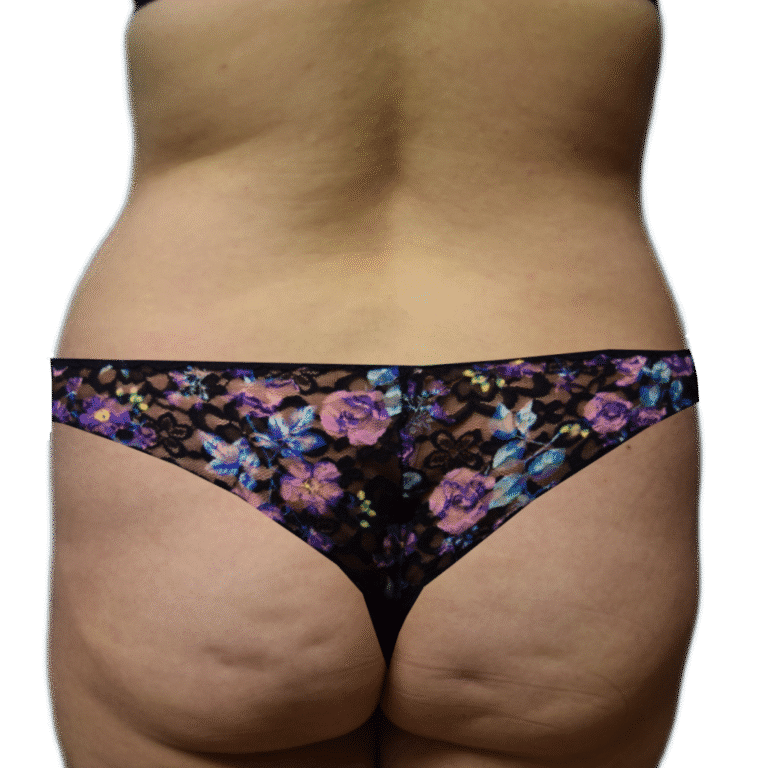 Before Image: BBL - back