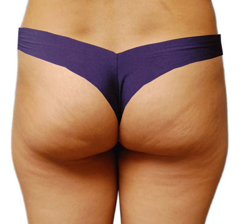 Before Image: BBL - back
