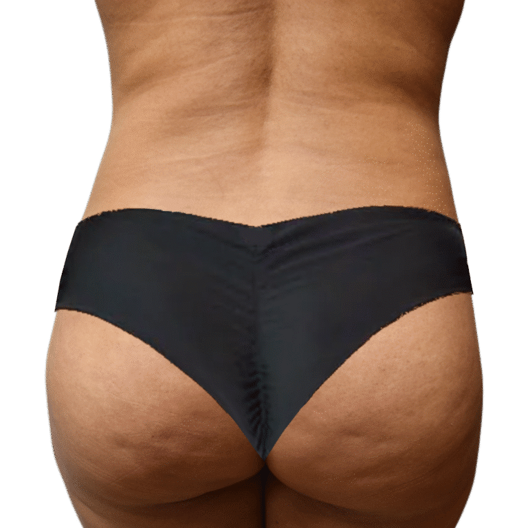 After Image: BBL - back