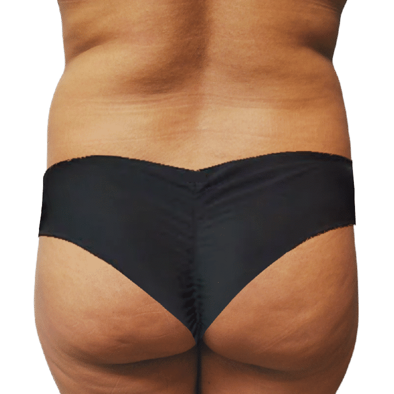 Before Image: BBL - back