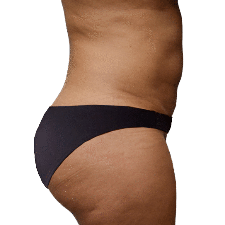 After Image: BBL - right-side