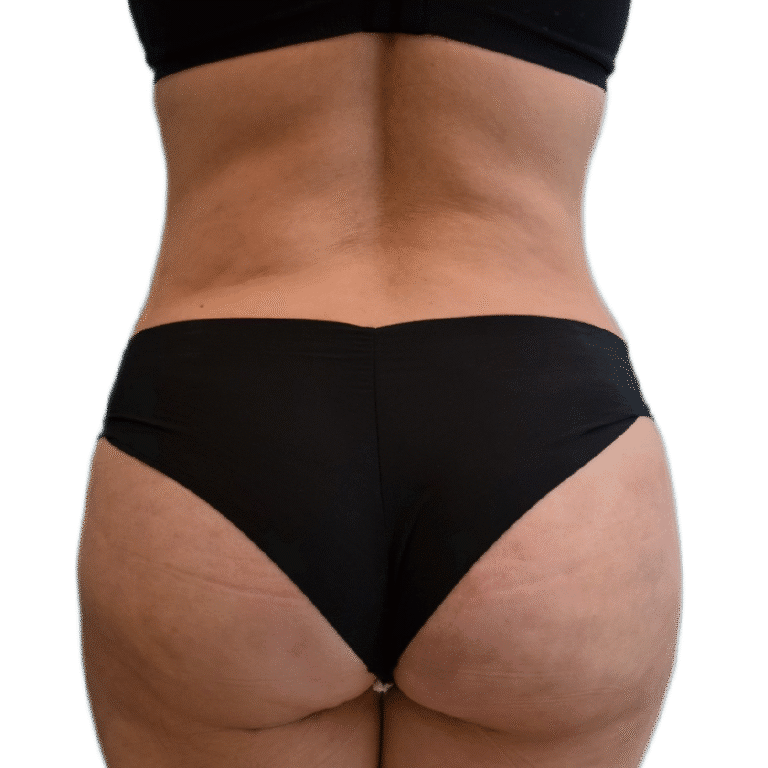 After Image: BBL - back