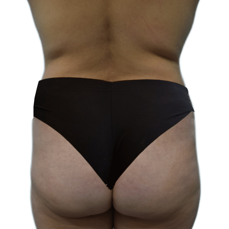 Before Image: BBL - back