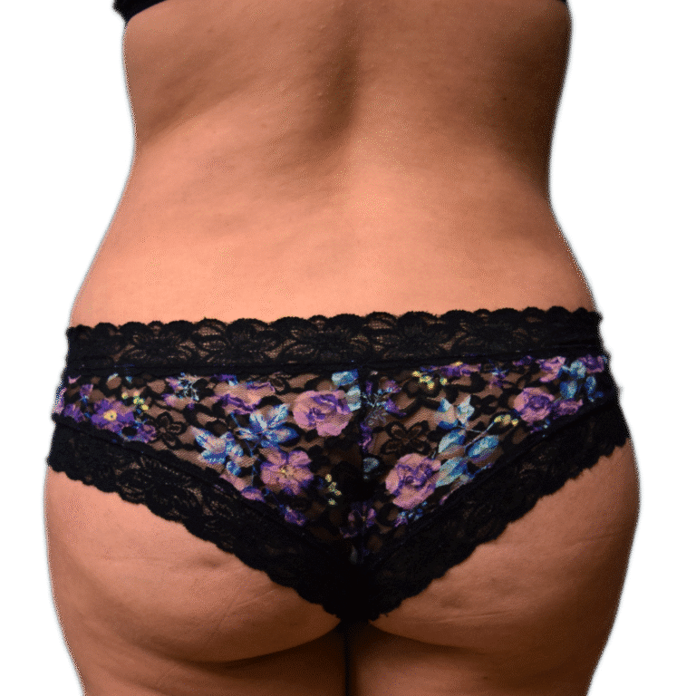 After Image: BBL - back