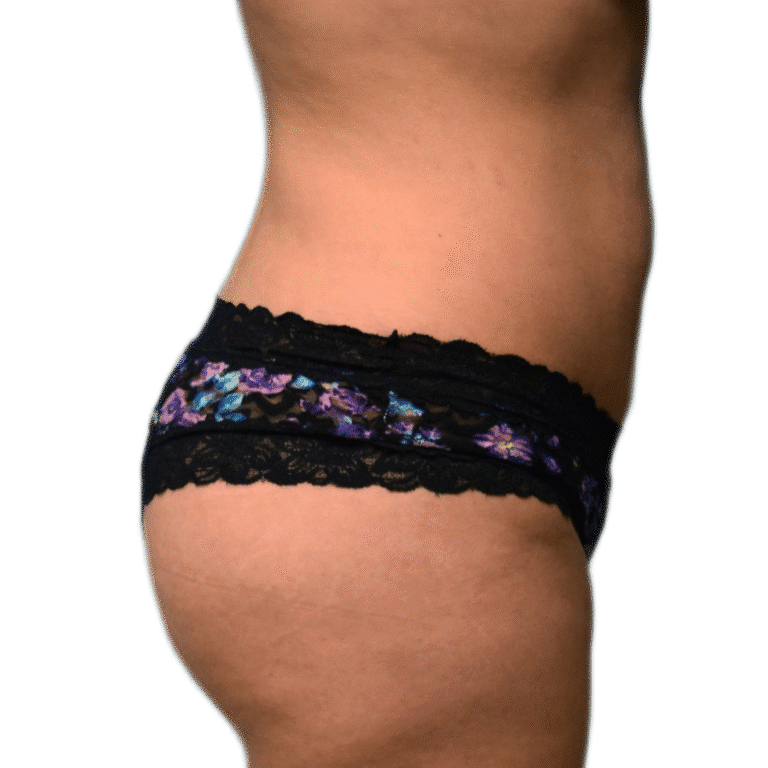 After Image: BBL - right-side