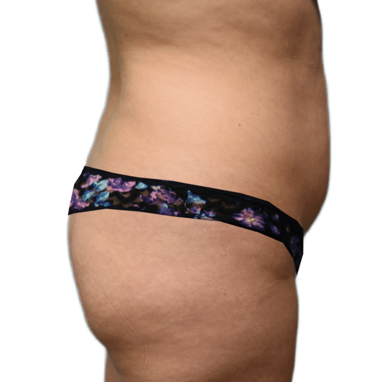Before Image: BBL - right-side