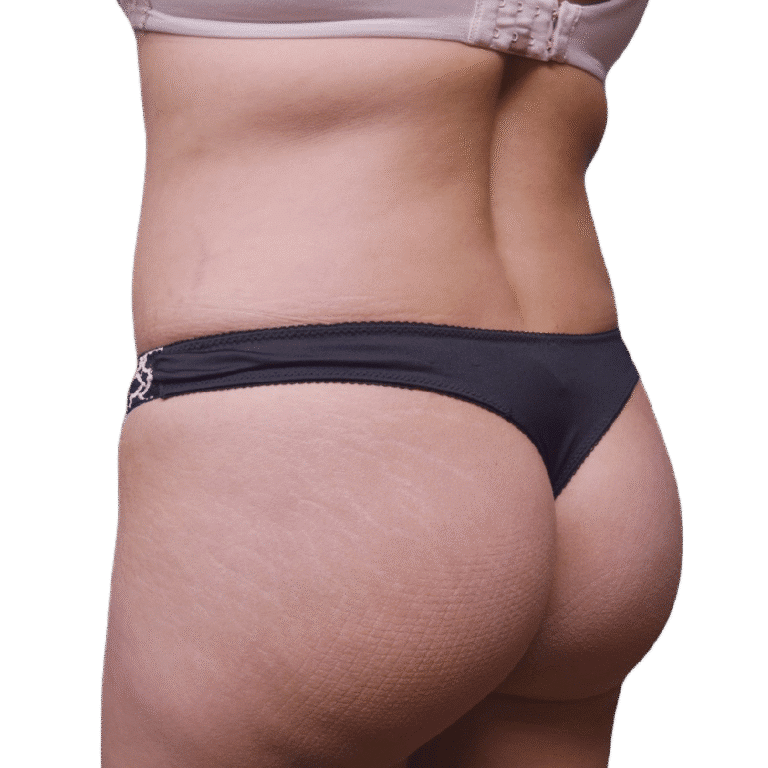 After Image: BBL - left-back-oblique