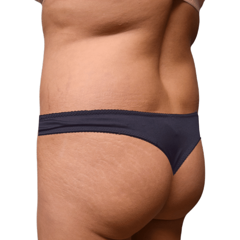 Before Image: BBL - left-back-oblique