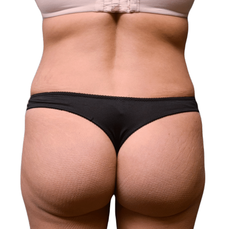 After Image: BBL - back