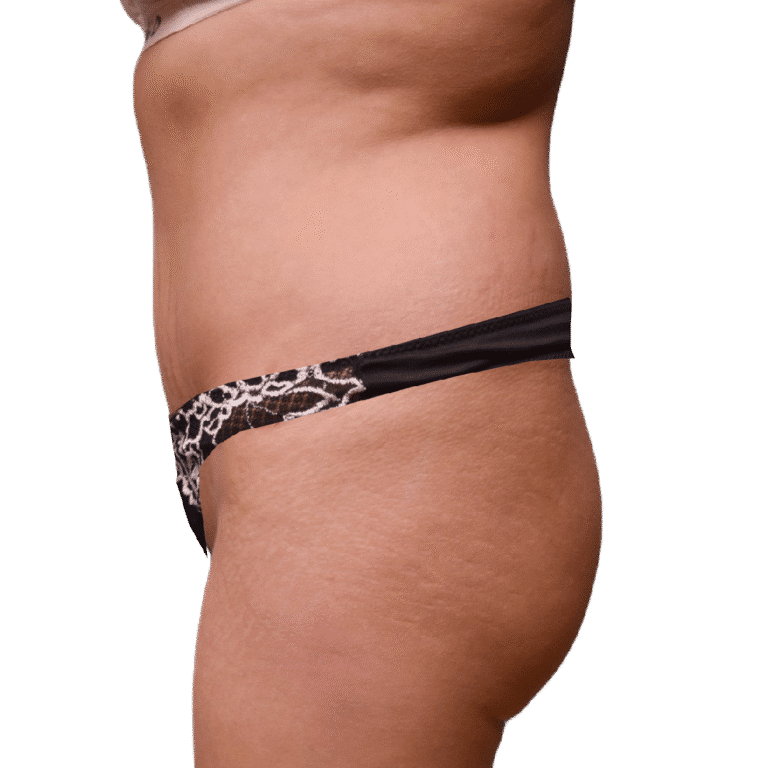 Before Image: BBL - left-side