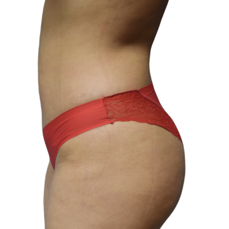 After Image: BBL - left-side