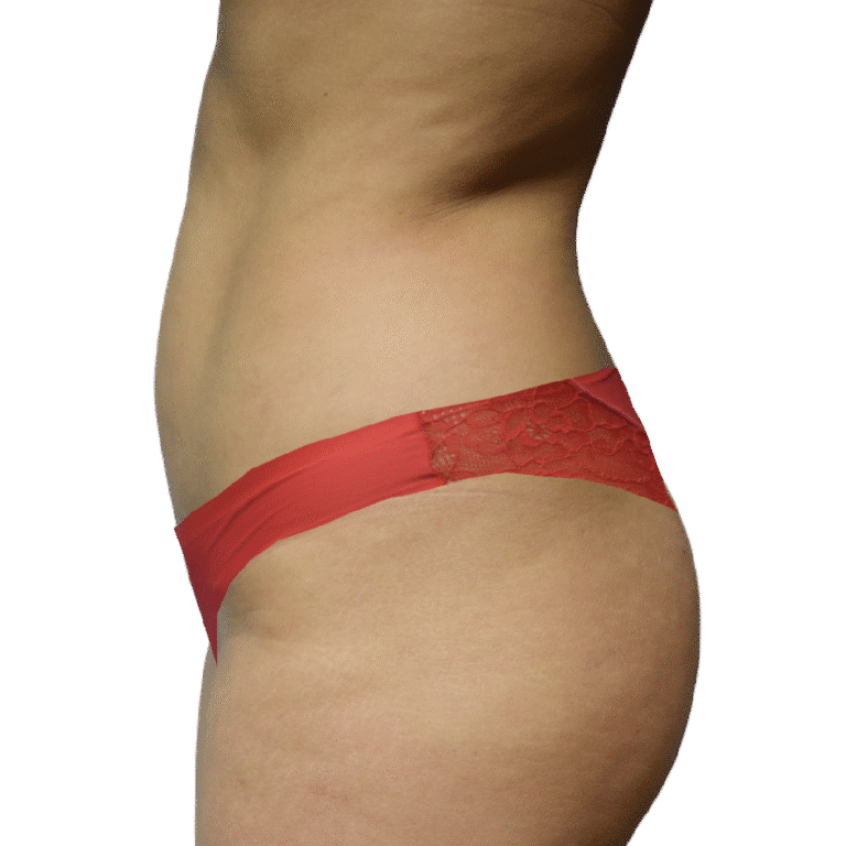 Before Image: BBL - left-side