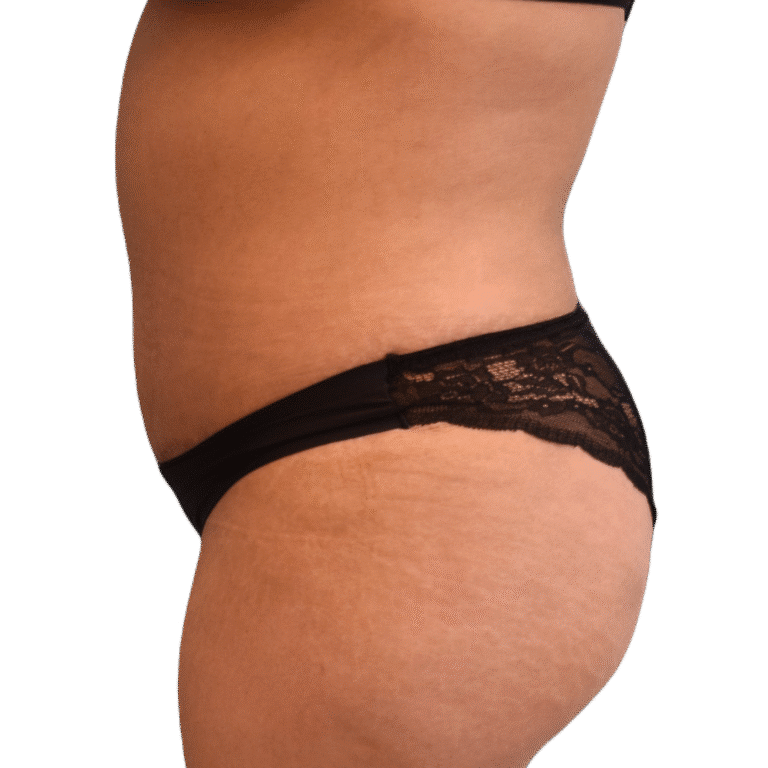 After Image: BBL - left-side